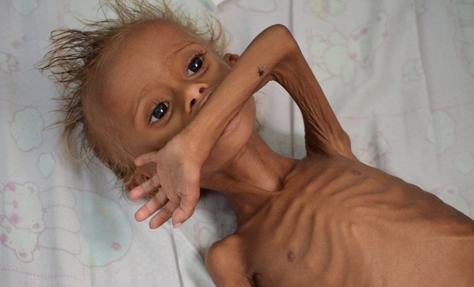 A malnourished boy lies on a bed at a hospital in the Red Sea port city of Houdieda, Yemen.