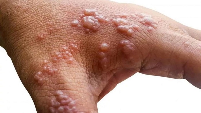 Las lesiones en la piel conforman uno de los síntomas más comunes para identificar el contagio por viruela símica.