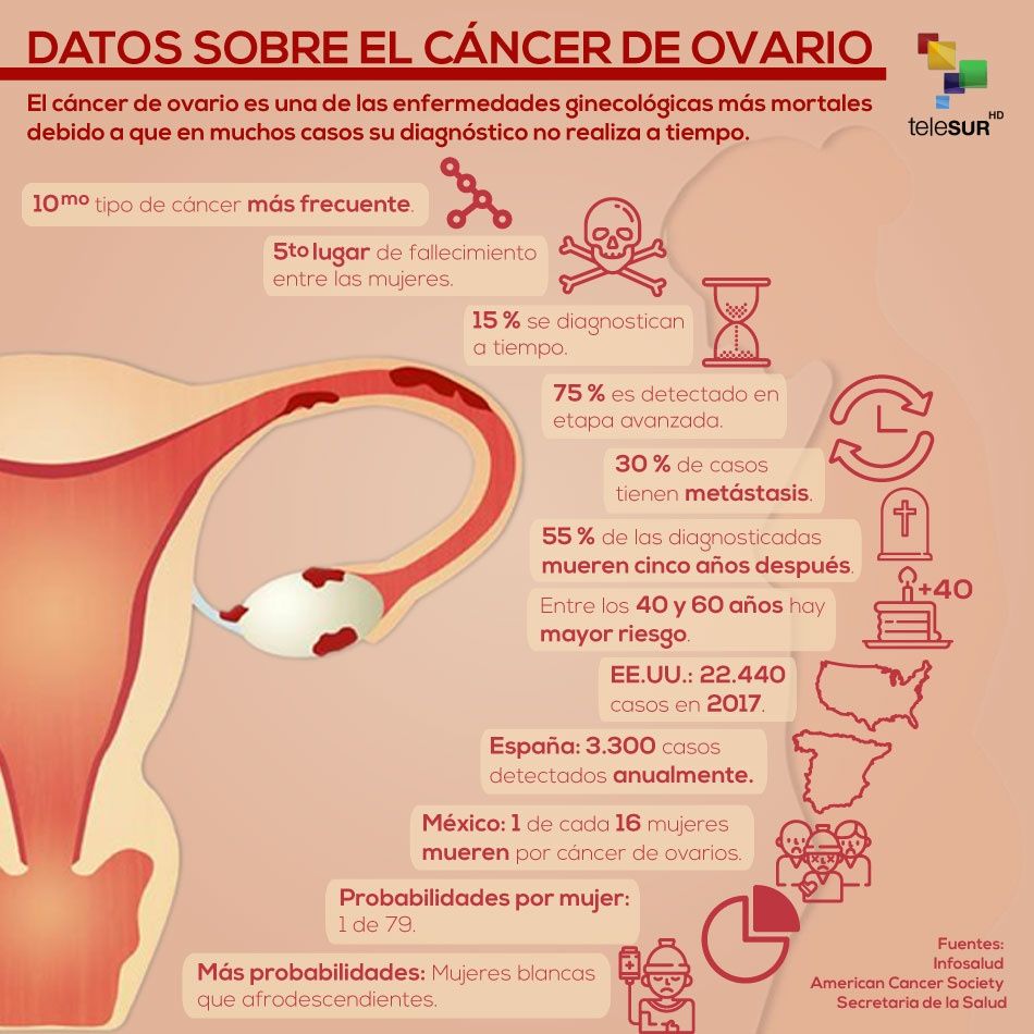 Cifras del cáncer de ovario