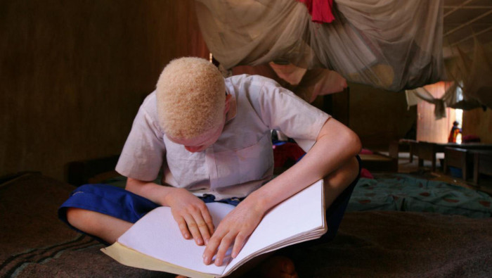 La ONU celebra cada 13 de junio el Día Internacional de Sensibilización sobre el Albinismo.