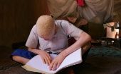 La ONU celebra cada 13 de junio el Día Internacional de Sensibilización sobre el Albinismo. 