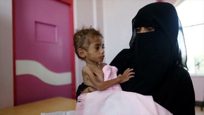 La malnutrición y la hambruna provocadas por la guerra ha cobrado la vida de casi 85.000 niños yemeníes hasta octubre de 2018.