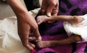 Alrededor del 61 por ciento de los infantes entre 6 y 24 meses padecen de desnutrición aguda en Guatemala.