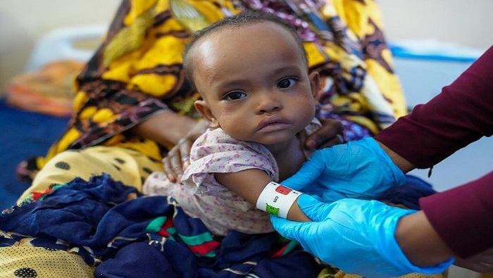 Al menos 386.000 niños y niñas en Somalia necesitan tratamiento por desnutrición severa.