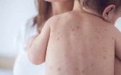 La rubeola es una enfermedad viral y contagiosa, marcada por la aparición de erupciones en la piel.